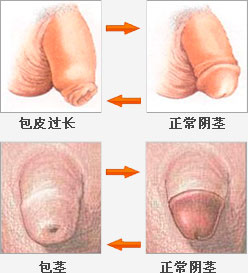 包皮包茎