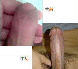 包皮手术效果对比